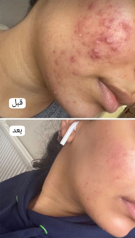 سروم ضد جوش و آکنه