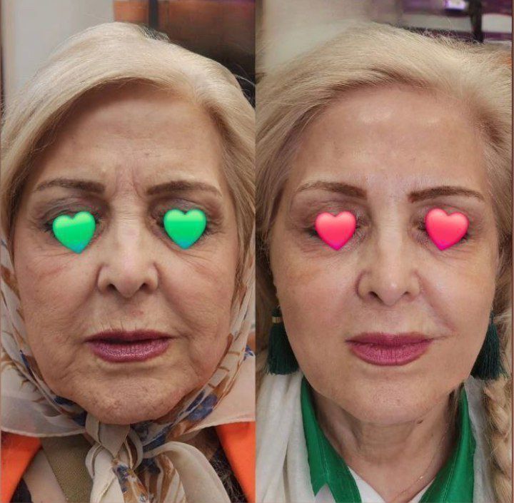 کرم لیفتیک و ضد چروک 100 میل  لاکچری کوین غلطک دار فرانسوی با ضمانت