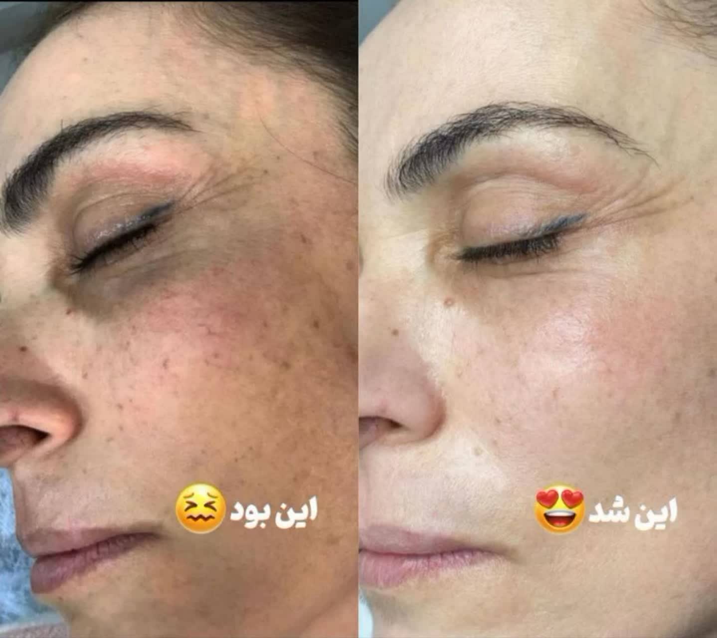 کرم بیوممتیک ضدلک و آکنه و ترمیم کننده لاکچری کوین فرانسه باضمانت