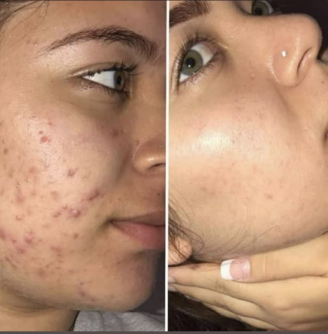 سروم بیوممتیک ضدجوش و لک وآکنه ۴۰میل لاکچری کوین فرانسه باضمانت بی قید و شرط