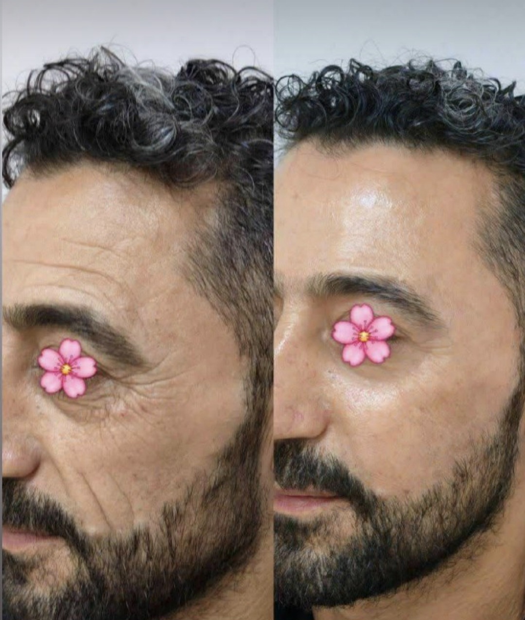 کرم رفع‌چین و چروک و لیفتینگ دائمی 5 کاره بیوممتیک اصلی اورجینال گاتیو فرانسه