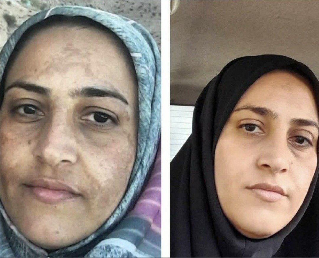 کرم بیوممتیک ضدلک و آکنه وضد کک و مک و ترمیم کننده جای بخیه ۱۰۰ میل لاکچری کوین فرانسه باضمانت