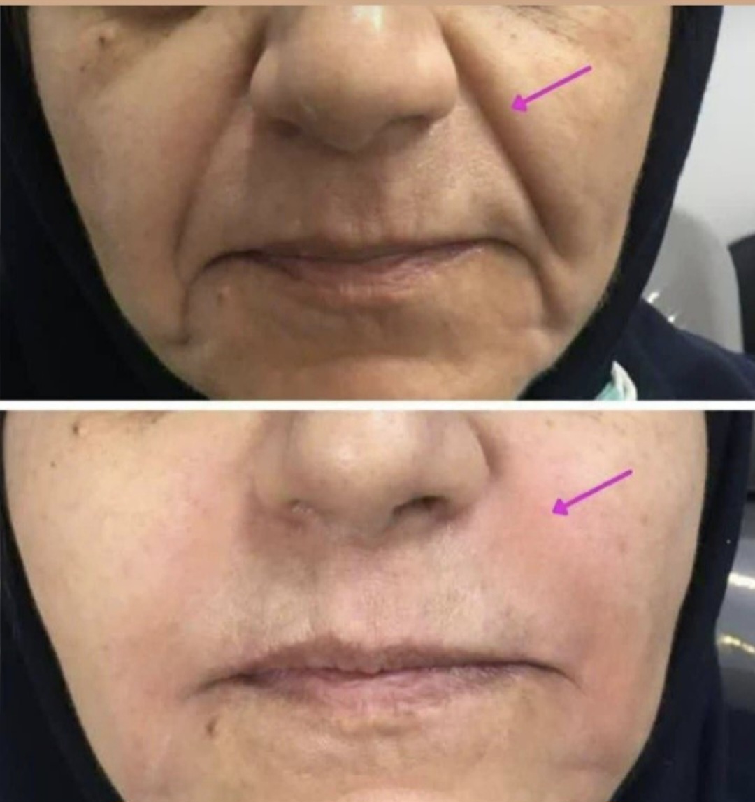 کرم بیوممتیک لیفتیک و ضد چروک 100 میل لاکچری کوین(معروف به اتوی پوست)غلطک دار فرانسوی با ضمانت